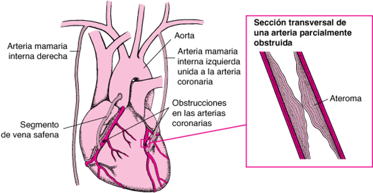 Injertos de revascularización coronaria (bypass coronario)