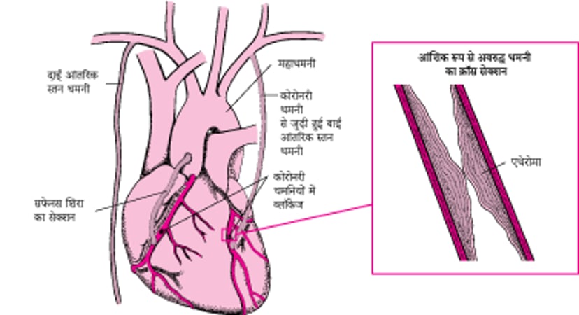 करोनरी धमनी बायपास ग्राफ्टिंग