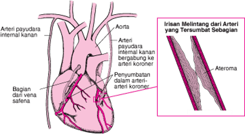 Pencangkokan Bypass Arteri Koroner
