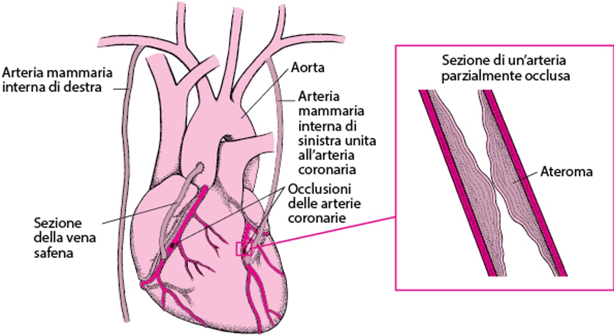 Innesto di bypass di arteria coronaria