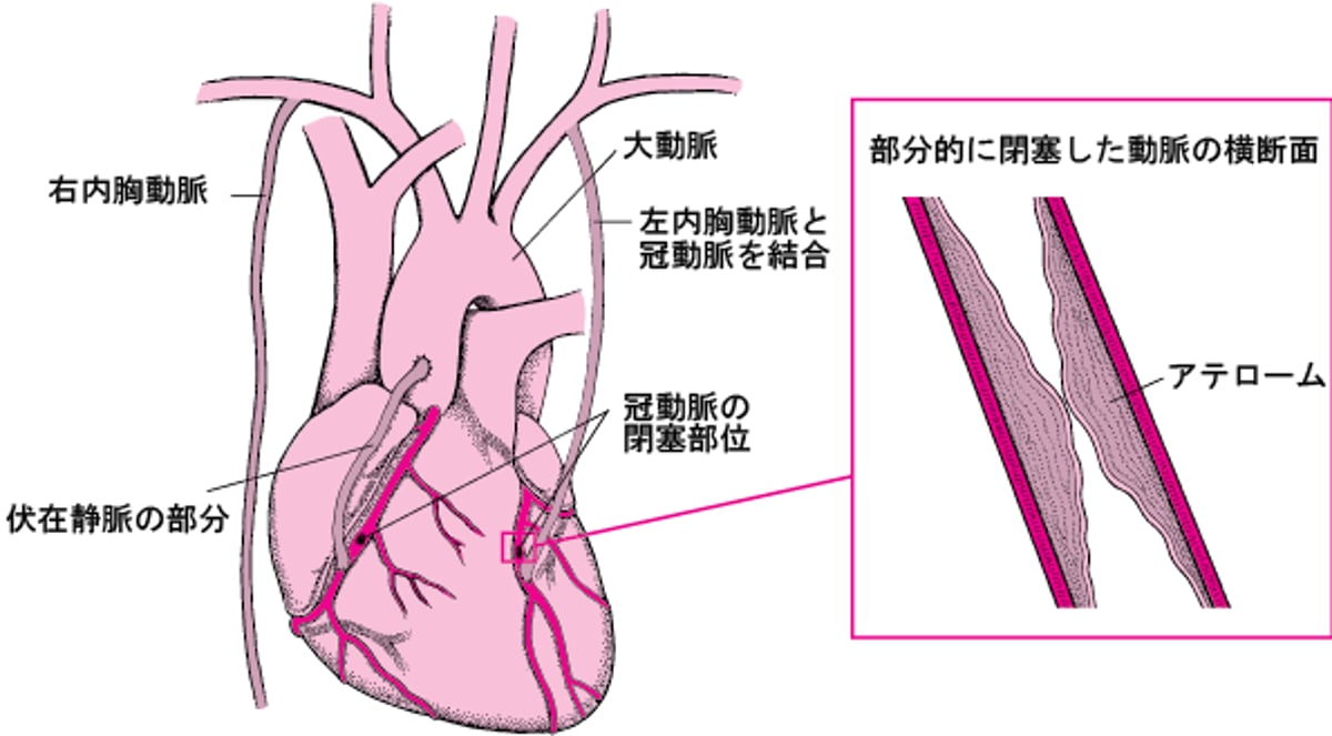 冠動脈バイパス術