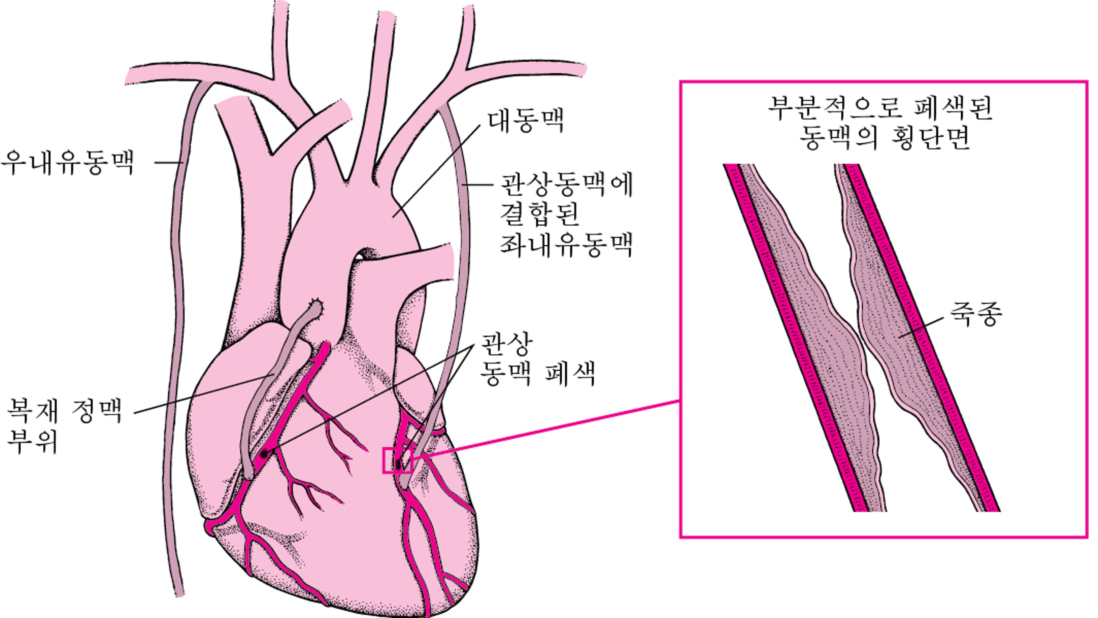 관상동맥 우회로 이식술