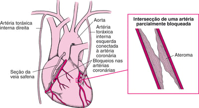 Cirurgia de revascularização do miocárdio