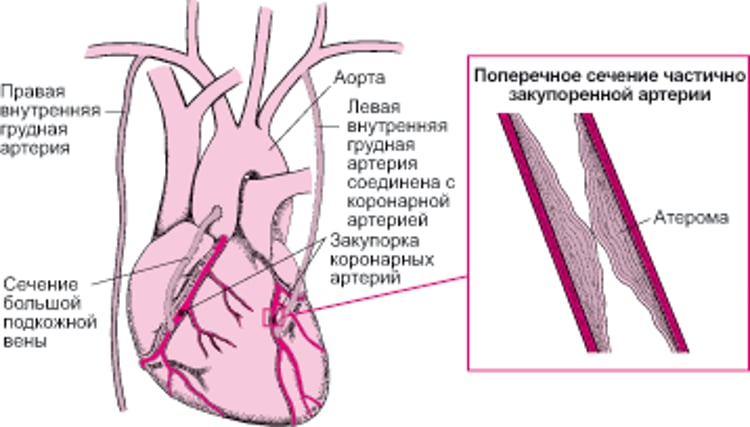 Аортокоронарное шунтирование