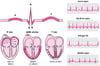 ECG: वेव्ज़ को पढ़ना