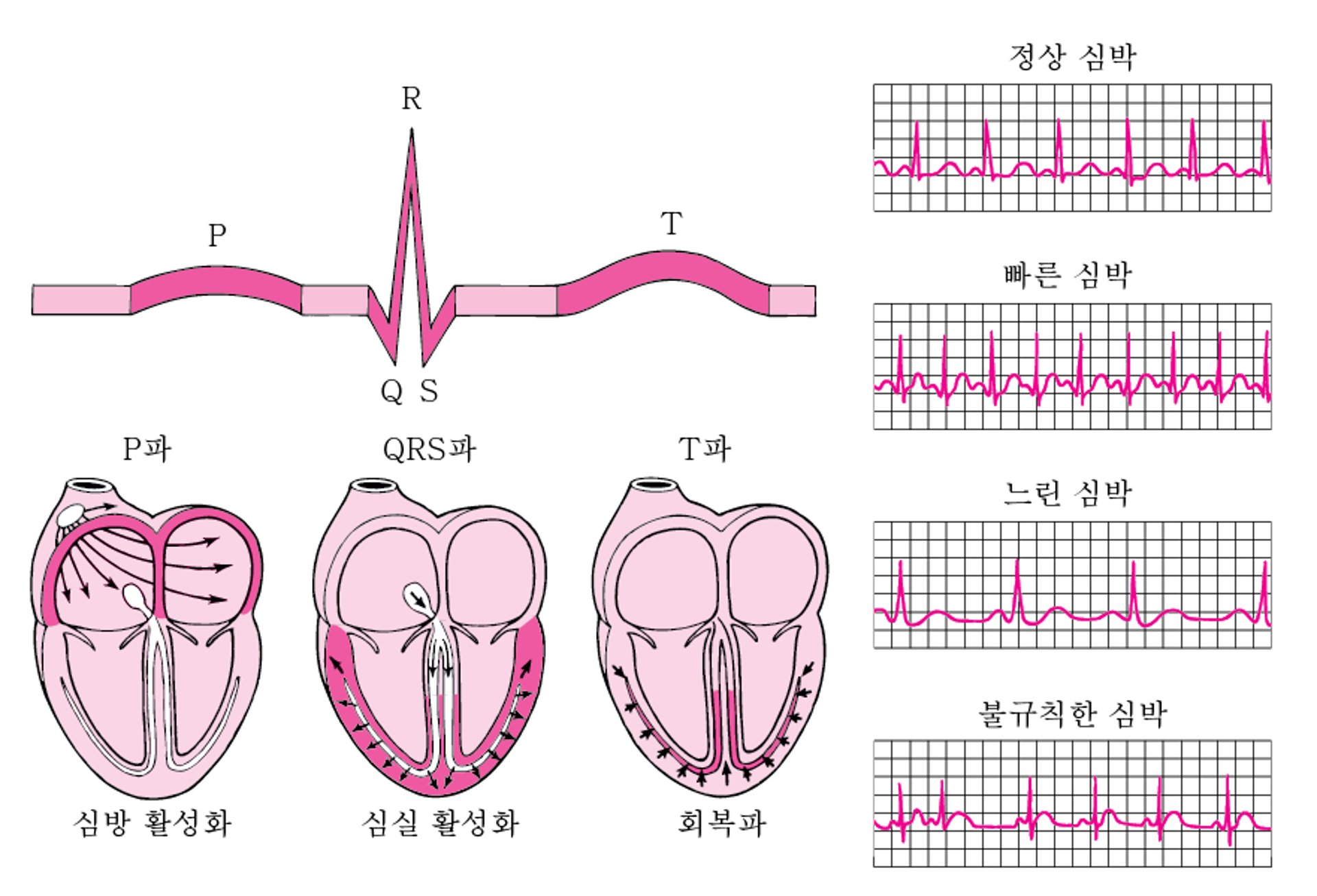 ECG: 파장 판독