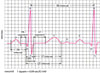 ECG: 파장 판독