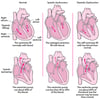 Heart Failure: Pumping and Filling Problems