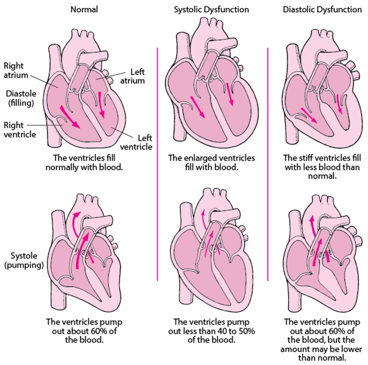 Heart Failure: Pumping and Filling Problems