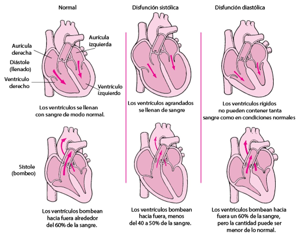 Insuficiencia cardíaca: problemas de bombeo y llenado