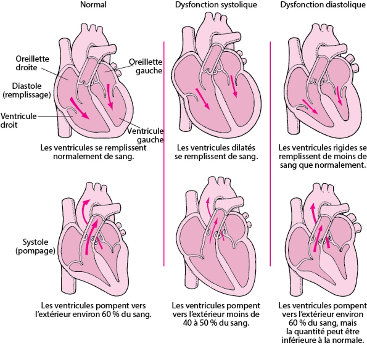 Insuffisance cardiaque : Anomalies du pompage et du remplissage