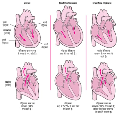 हार्ट फेल्यूर: पंप करने और भरने की समस्याएं