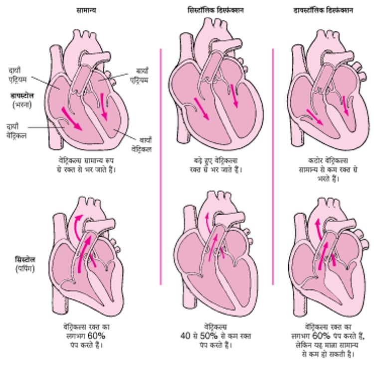 हार्ट फेल्यूर: पंप करने और भरने की समस्याएं