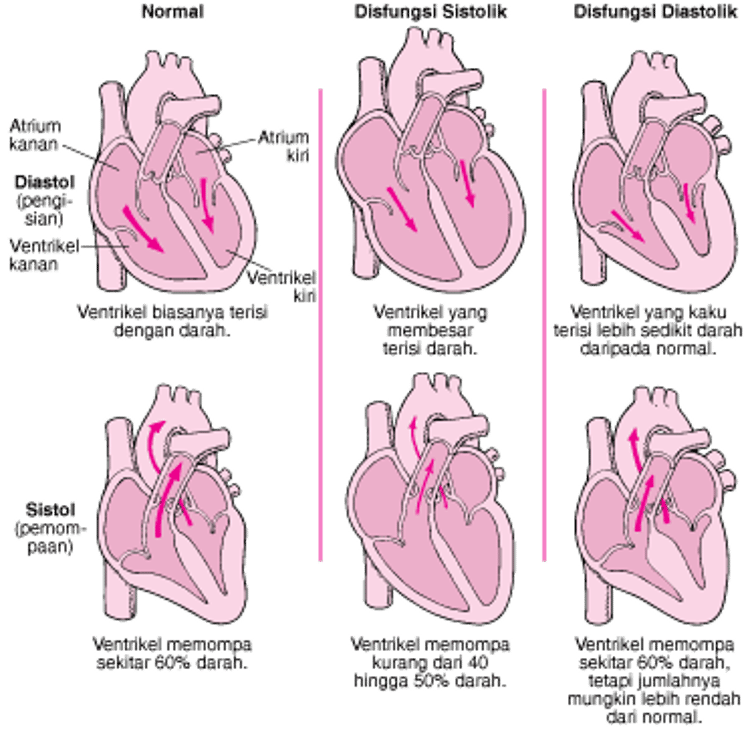 Gagal Jantung: Masalah Pemompaan dan Pengisian Darah