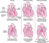 Insufficienza cardiaca: problemi di pompaggio e di riempimento