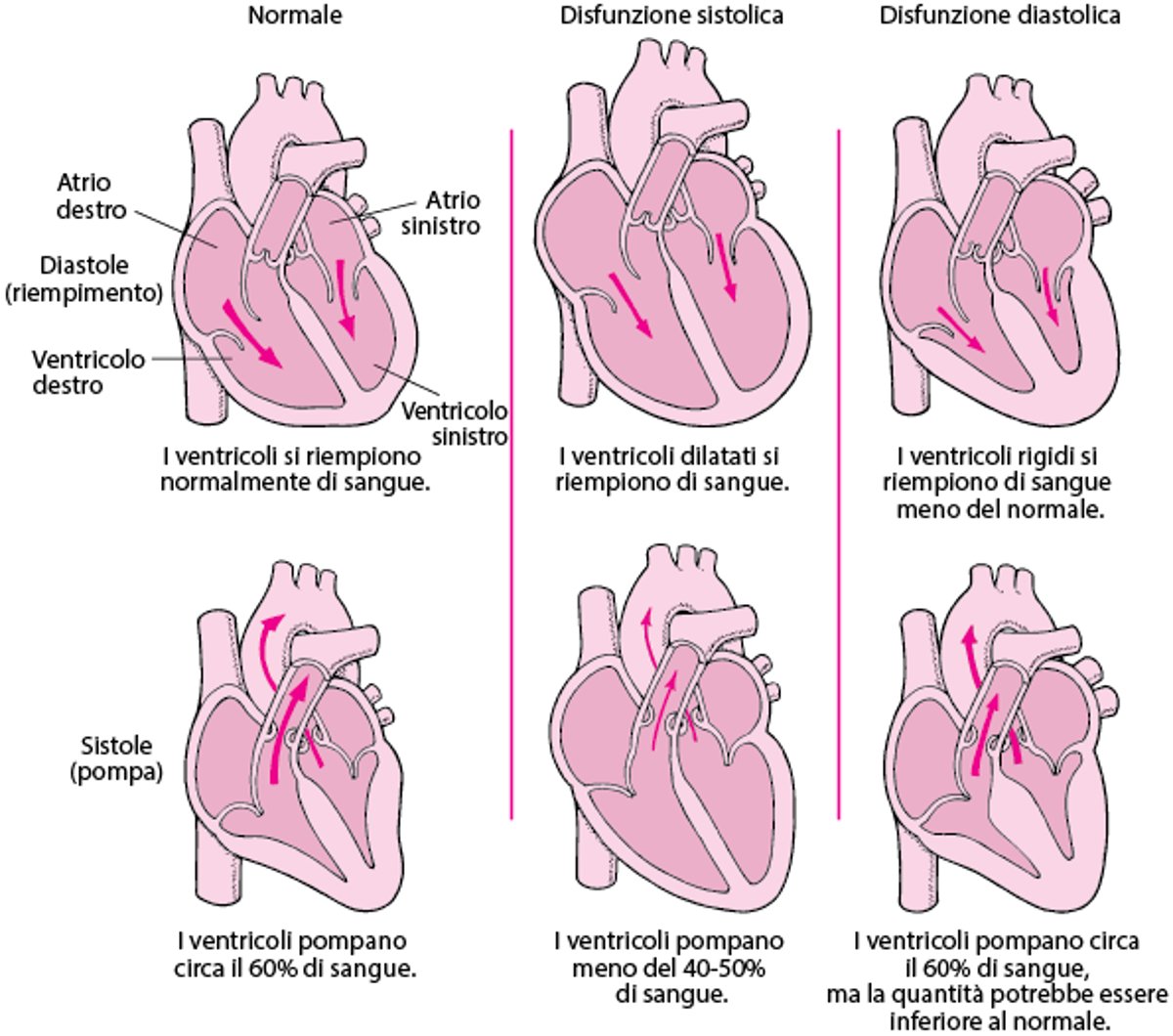 Insufficienza cardiaca: problemi di pompaggio e di riempimento