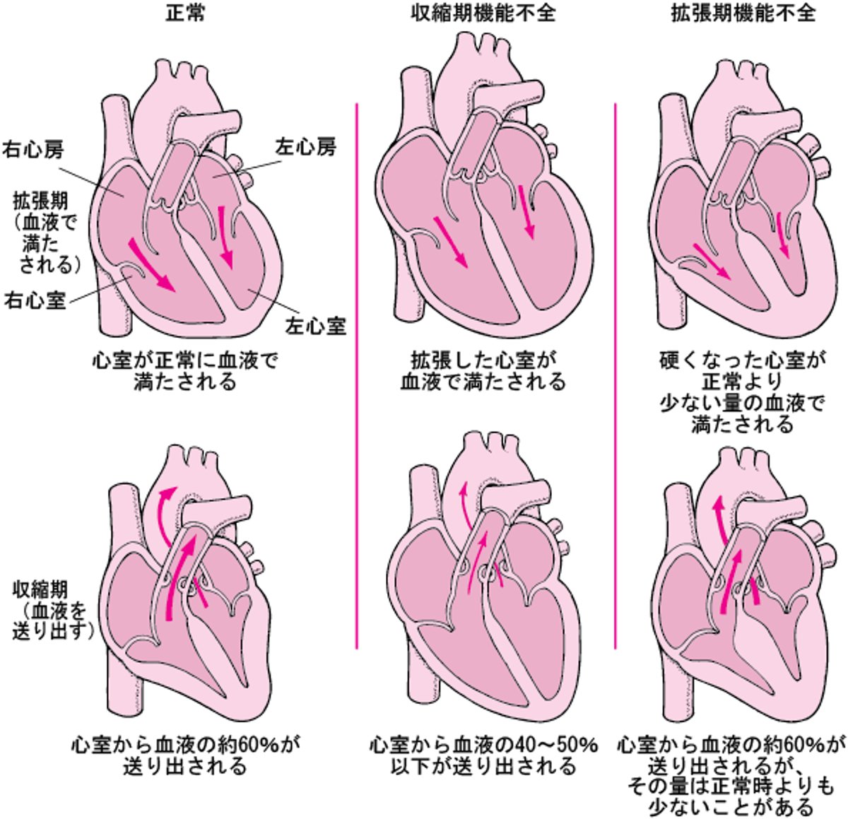 心不全：拡張機能障害と収縮機能障害