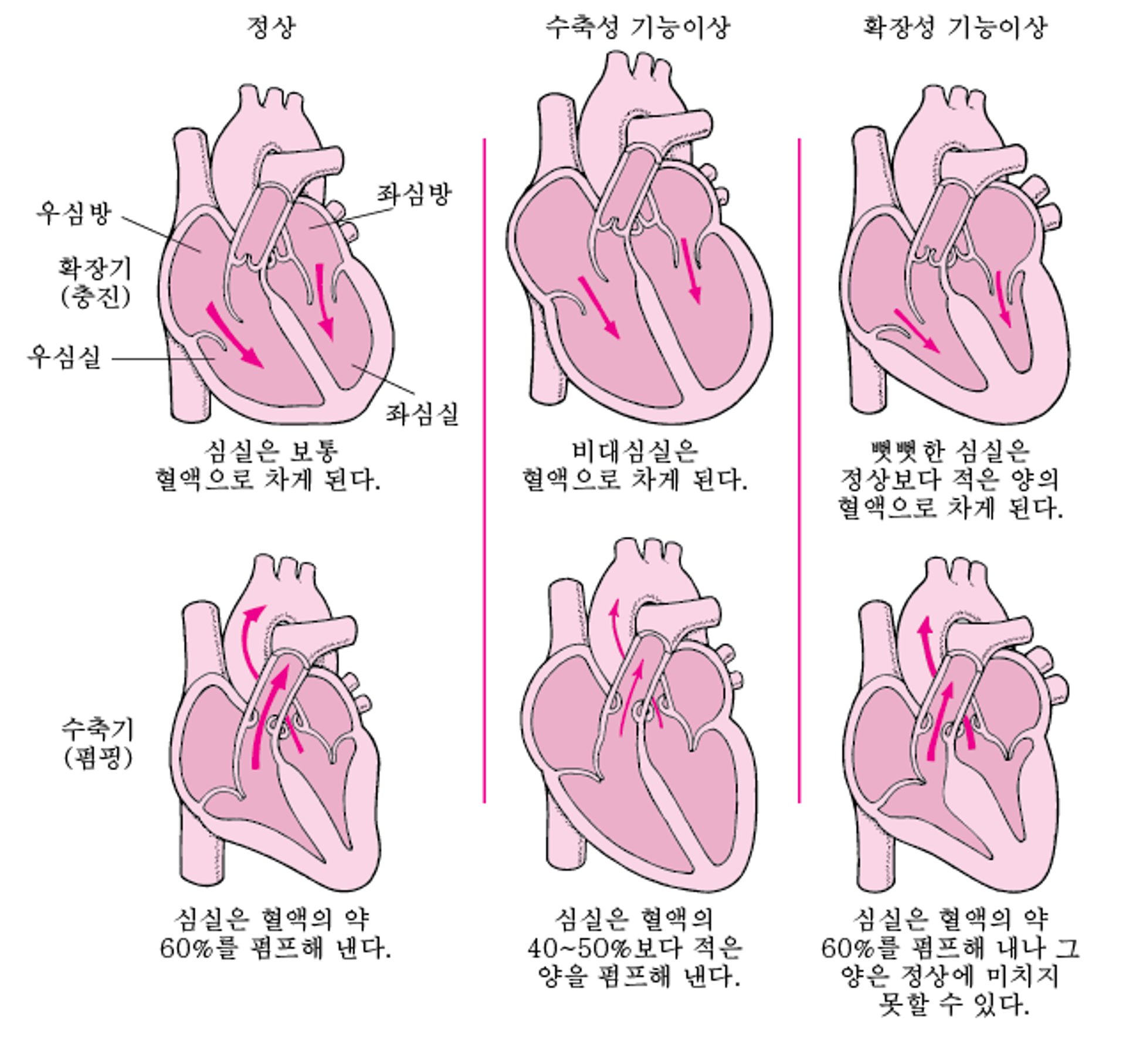 심부전: 혈액을 내보내고 채우는 문제