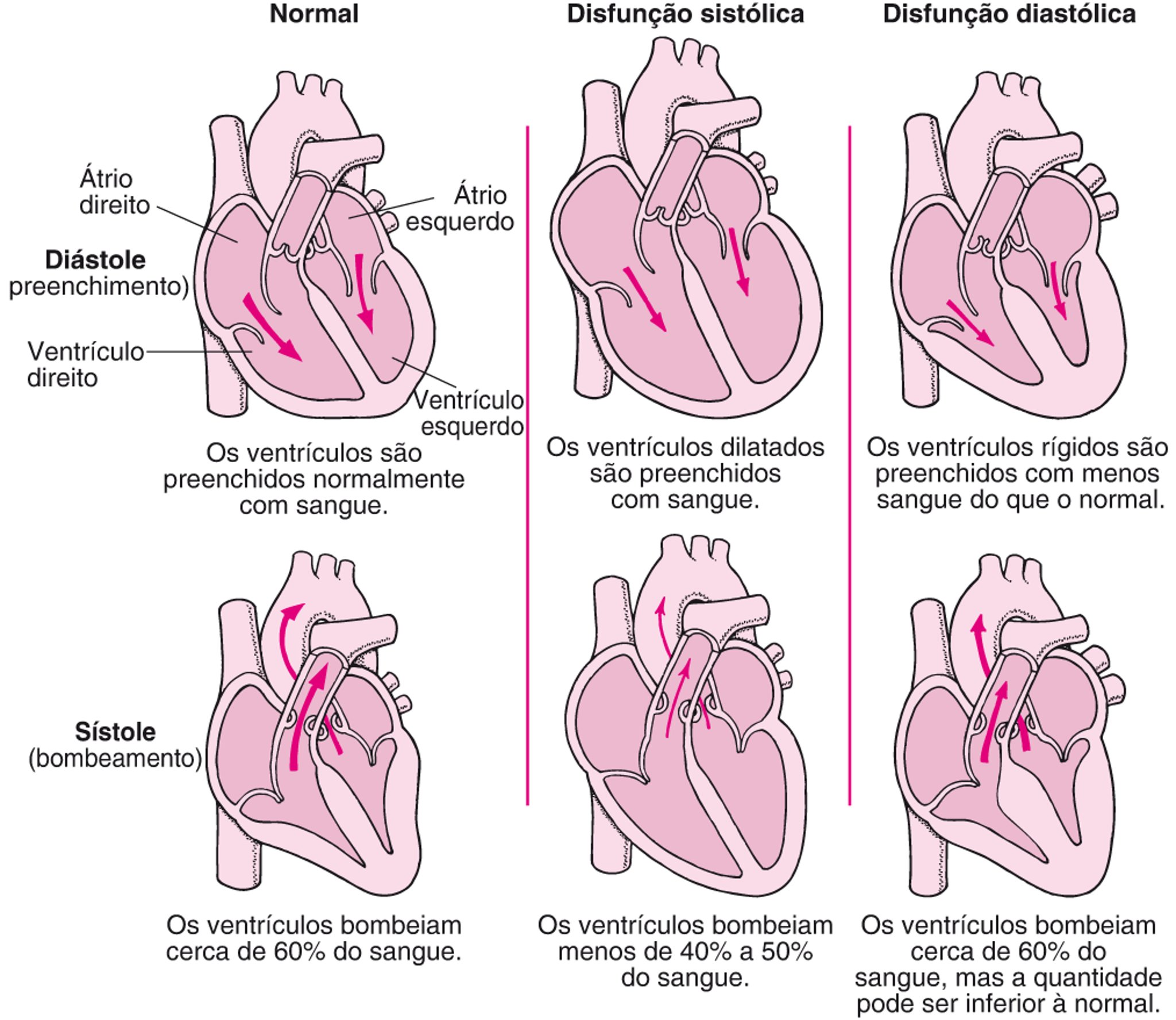 Insuficiência cardíaca: Problemas de bombeamento e preenchimento