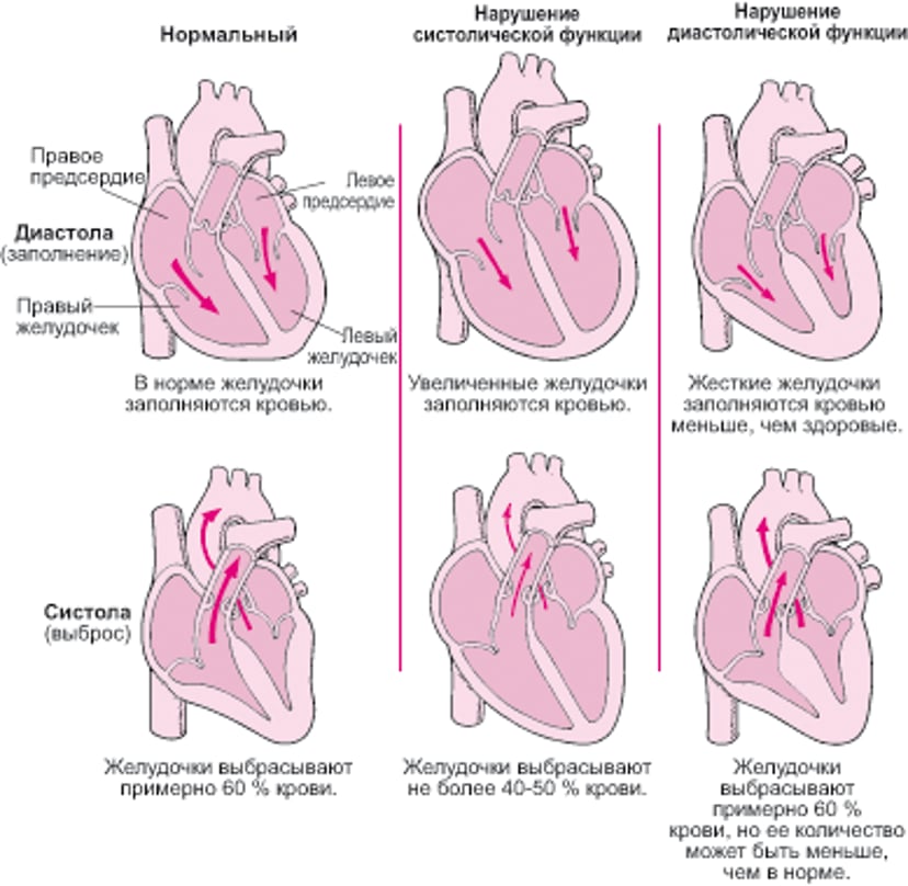 Сердечная недостаточность: Нарушения сократительной и наполняющей способности