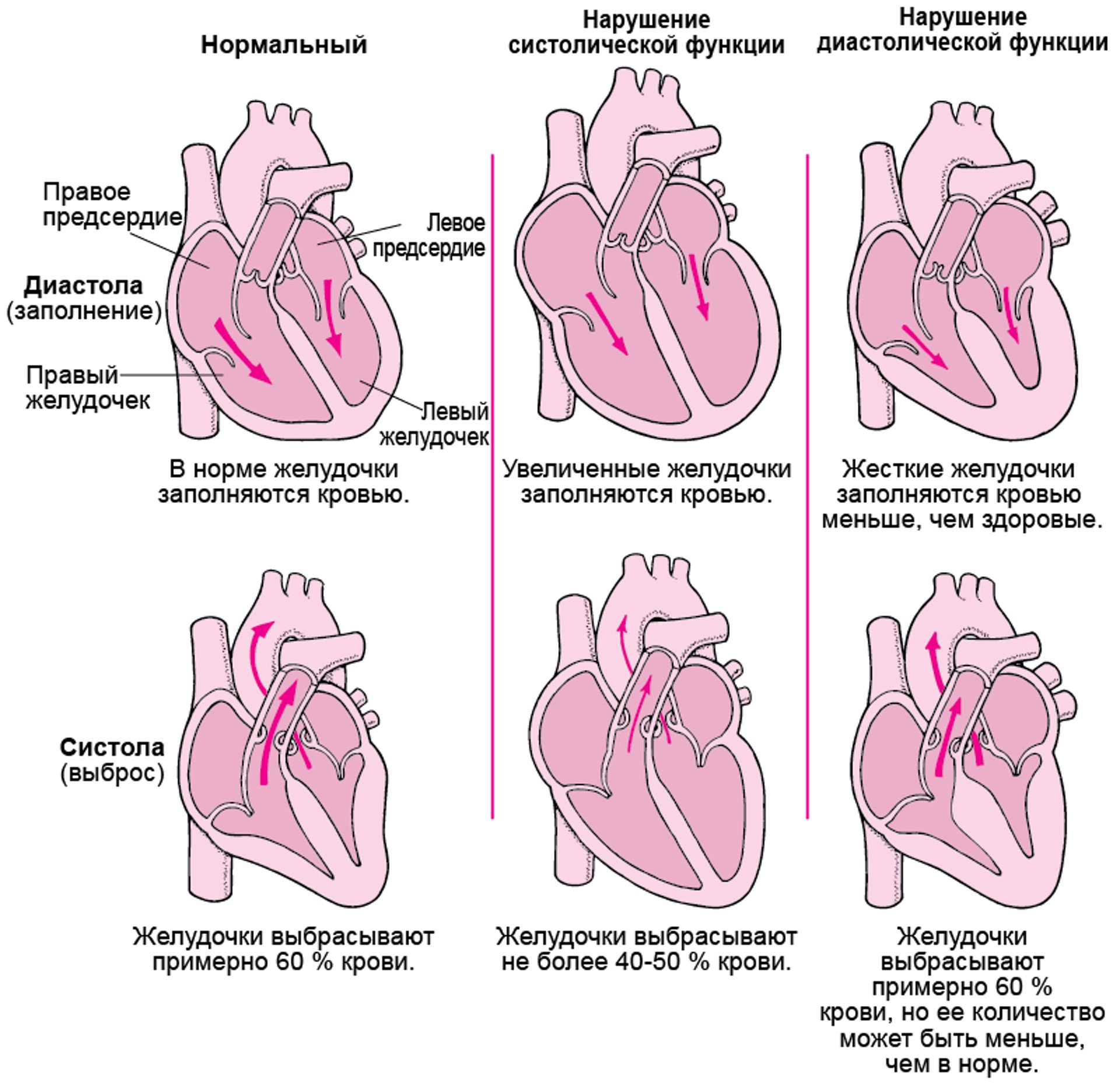 Сердечная недостаточность: Нарушения сократительной и наполняющей способности