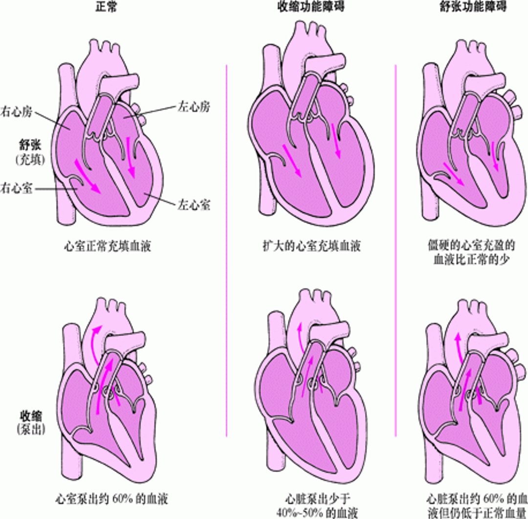 心力衰竭：泵出和充盈障碍
