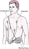 Holter-Monitor: Durchgehende EKG-Aufzeichnungen