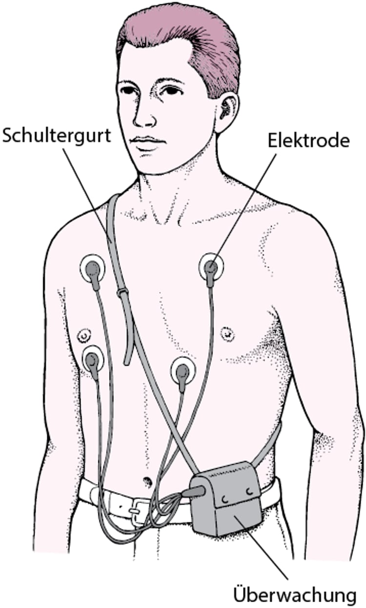 Holter-Monitor: Durchgehende EKG-Aufzeichnungen