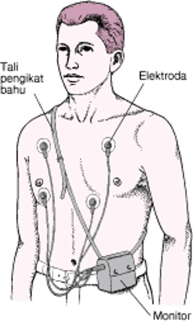 Monitor Holter: Bacaan EKG Berkelanjutan