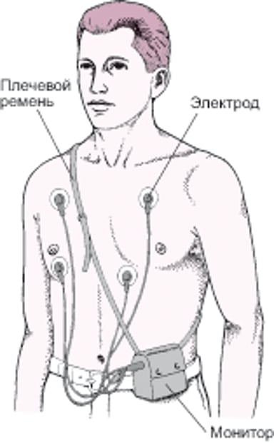 Холтеровский монитор: Непрерывная запись ЭКГ