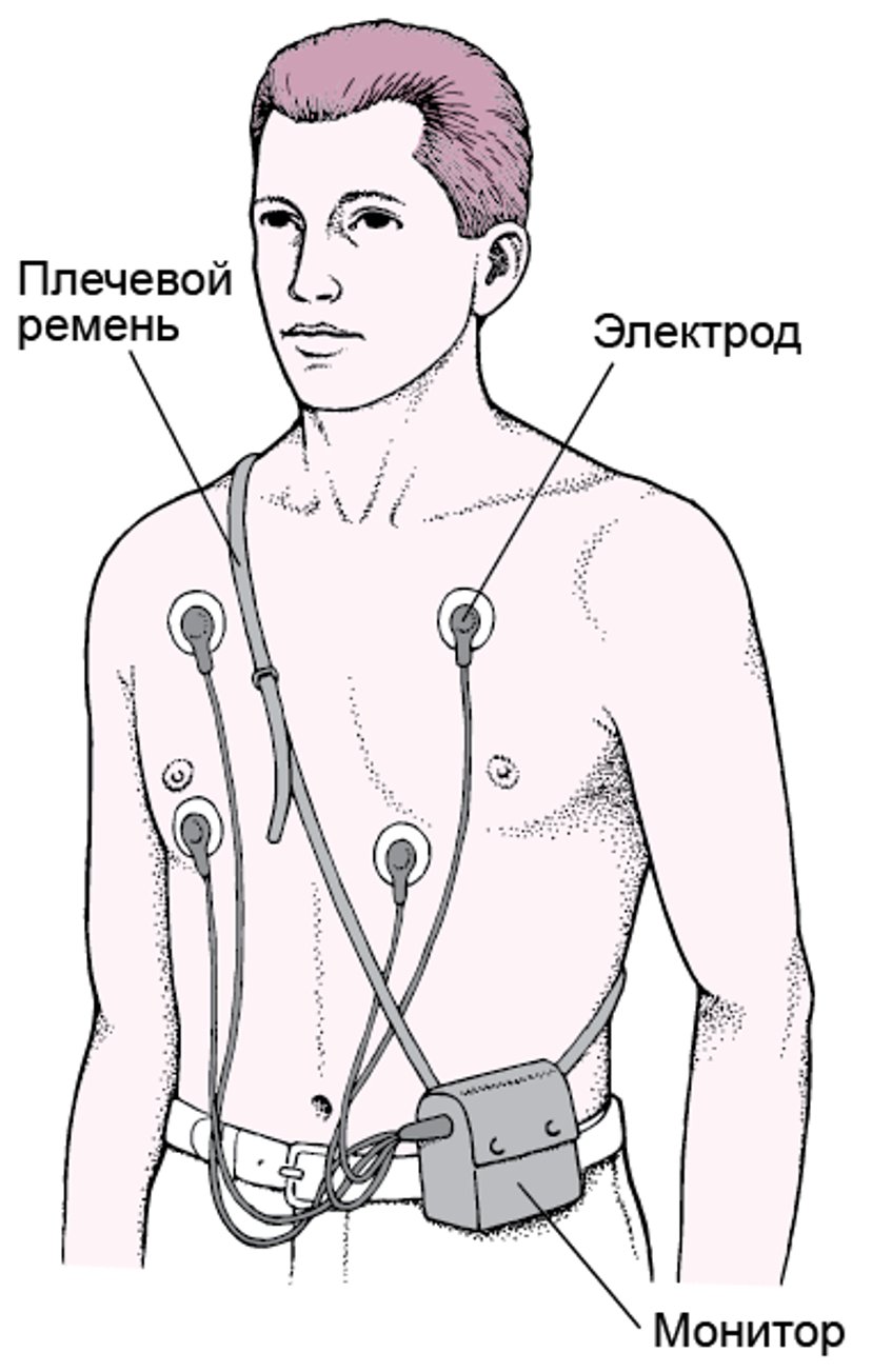 Холтеровский монитор: Непрерывная запись ЭКГ