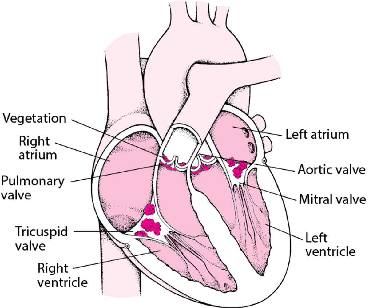 An Inside View of Infective Endocarditis