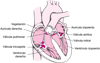 Vista interior de una endocarditis infecciosa