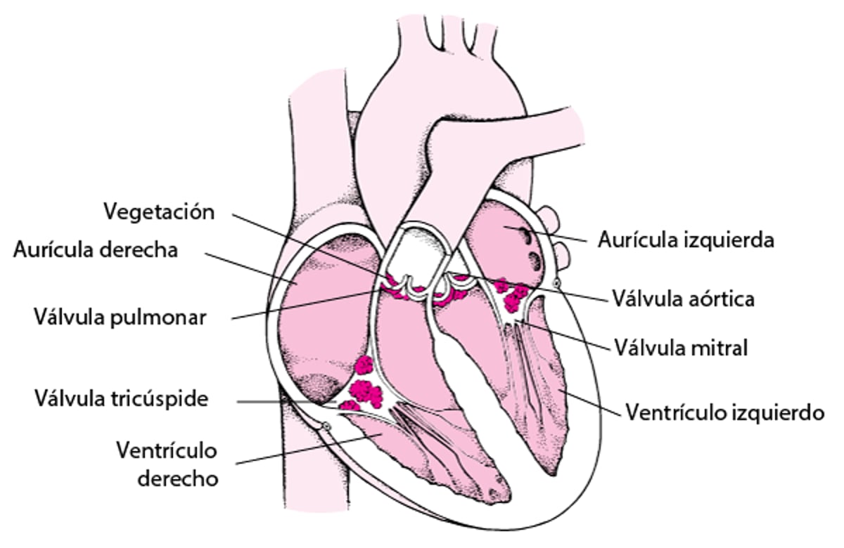 Vista interior de una endocarditis infecciosa