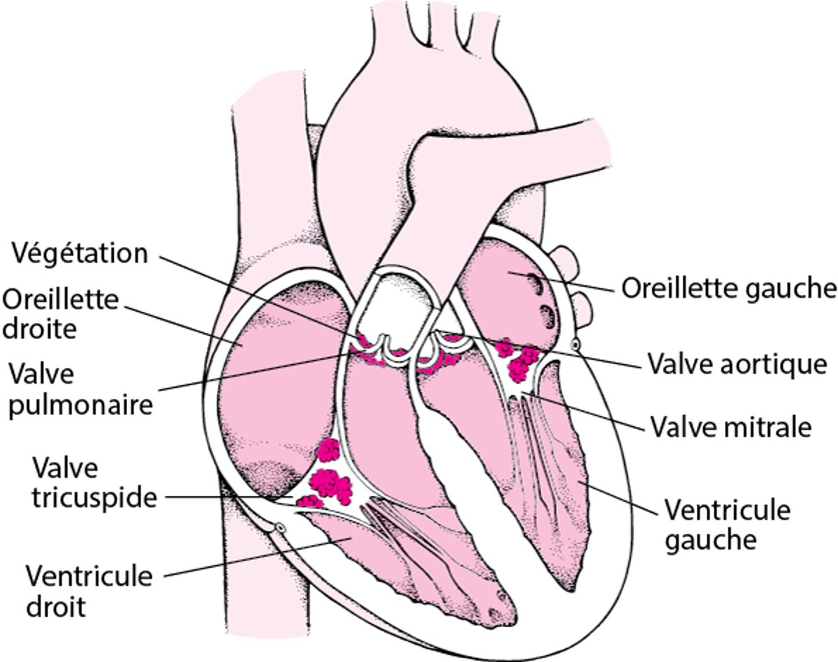 Vue intérieure de l’endocardite infectieuse