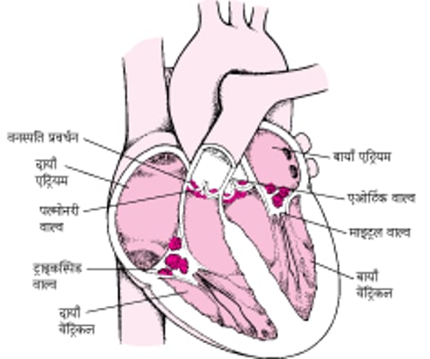 इनफेक्टिव एंडोकार्डाइटिस के भीतर का दृश्य