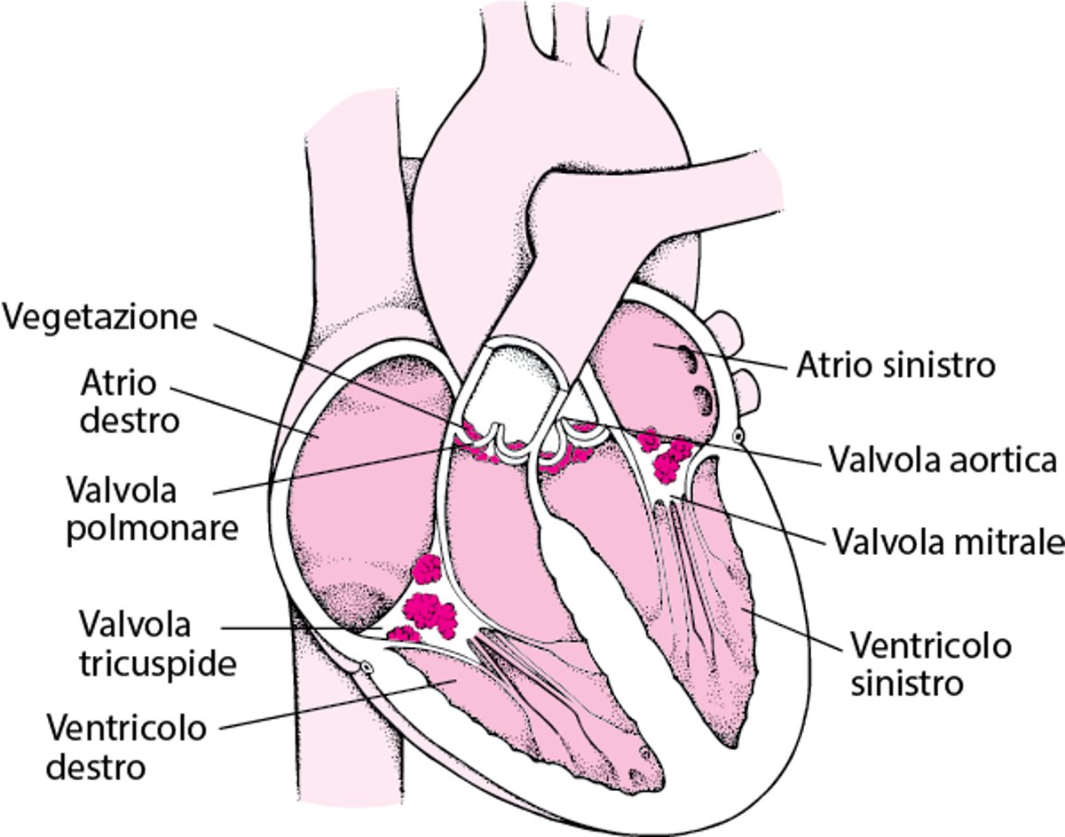 Sezione interna di un’endocardite infettiva