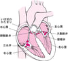 感染性心内膜炎を起こした心臓の内部