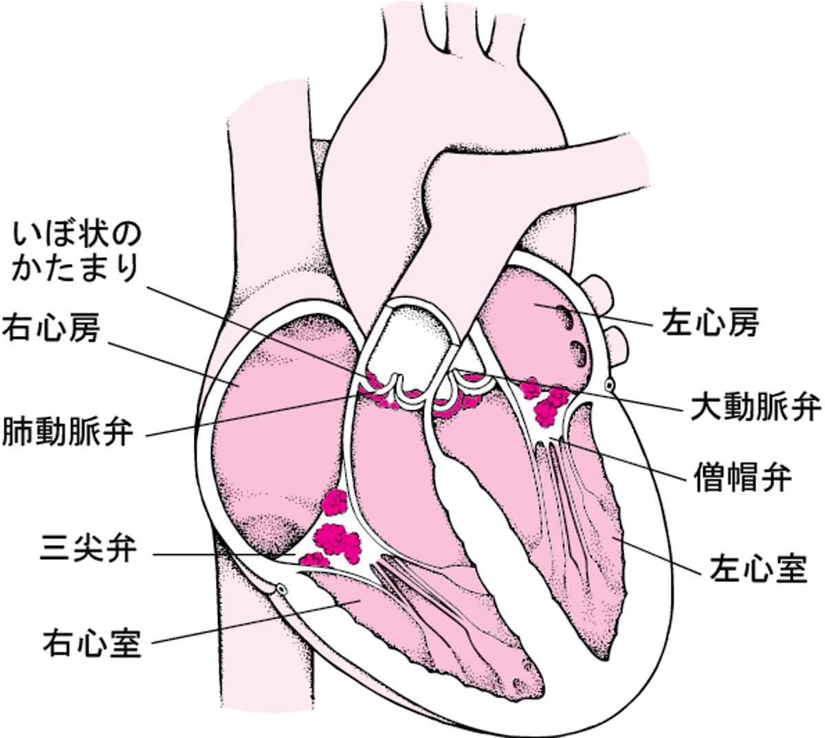 感染性心内膜炎を起こした心臓の内部