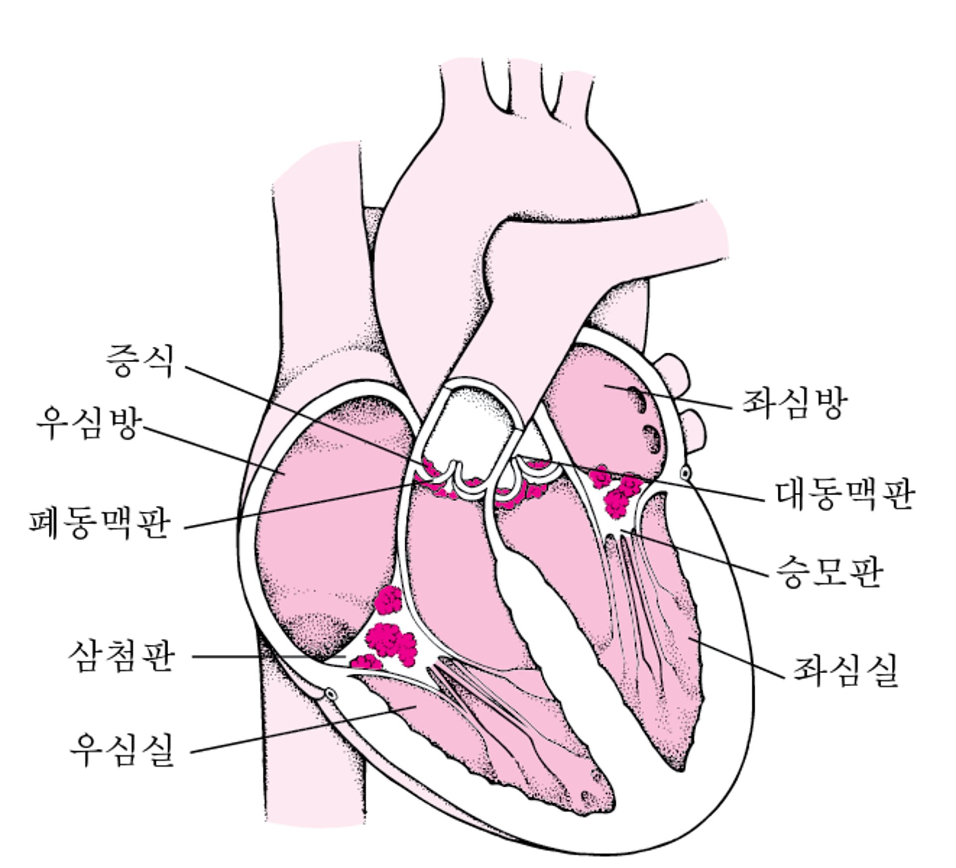 감염성 심내막염의 내면 관찰