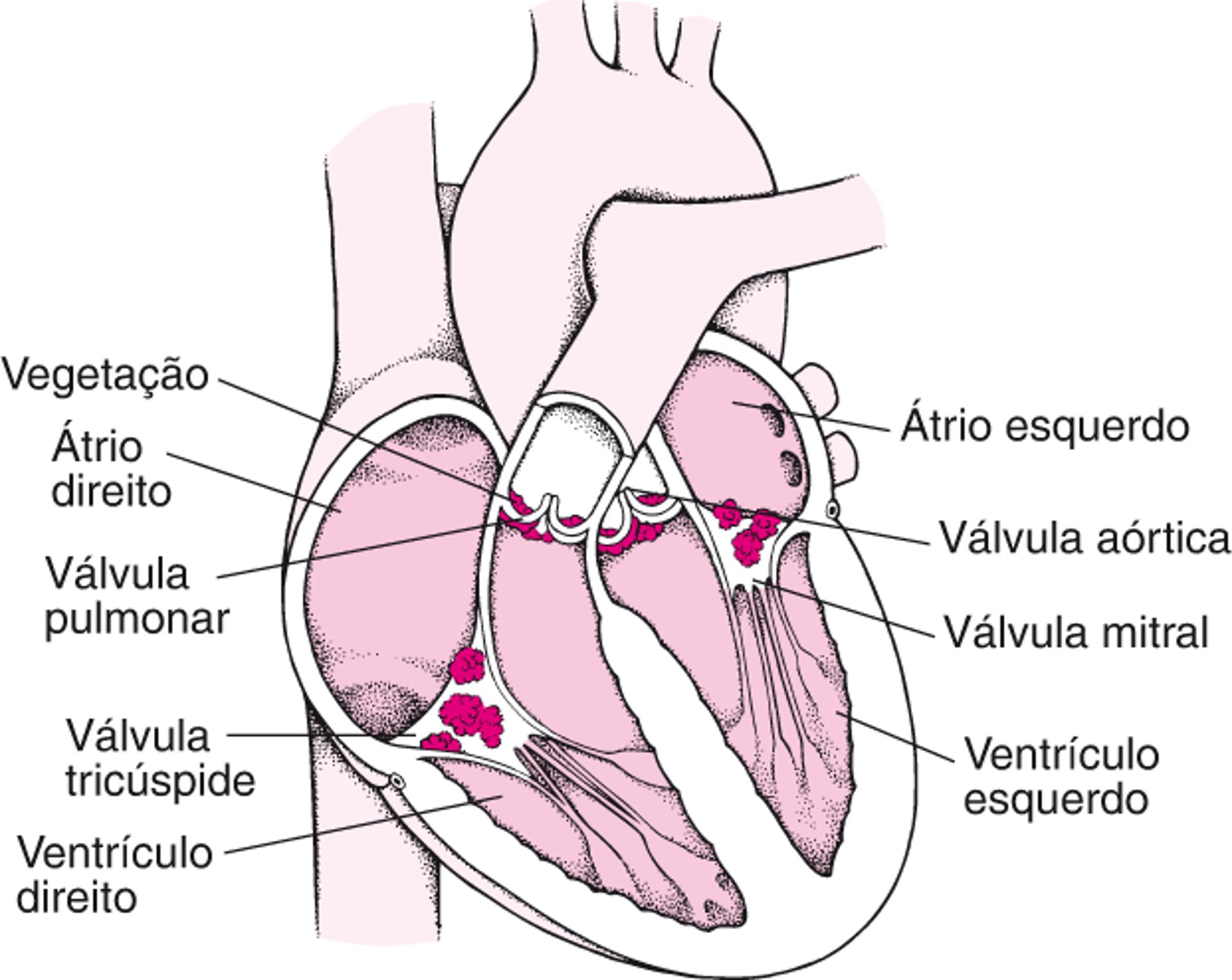Por dentro da endocardite infecciosa