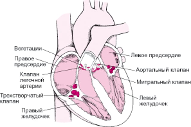 Взгляд на инфекционный эндокардит изнутри