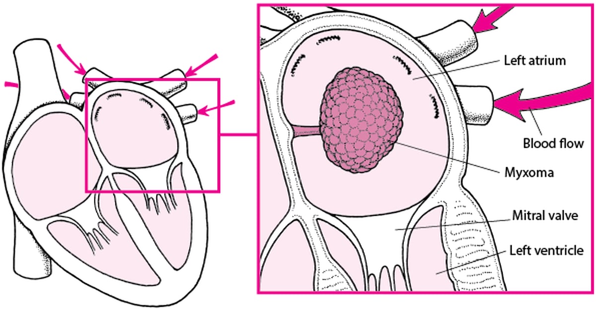 How a Myxoma Can Block Blood Flow in the Heart