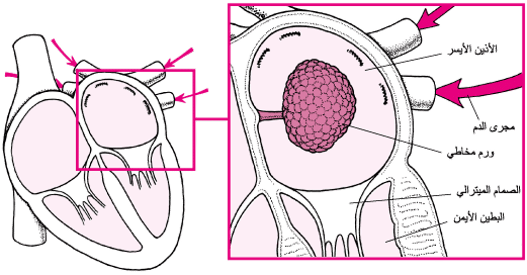 كيف يمكن للورم المخاطي أن يمنع تدفق الدَّم في القلب