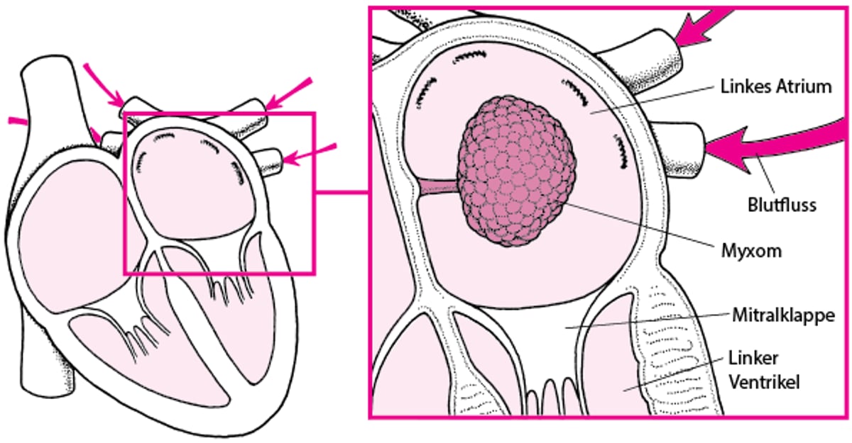 Wie ein Myxom den Blutfluss im Herzen blockieren kann