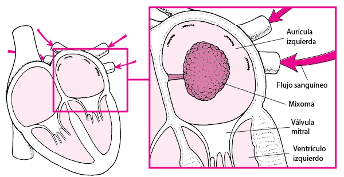 Obstrucción del flujo sanguíneo en el corazón por un mixoma