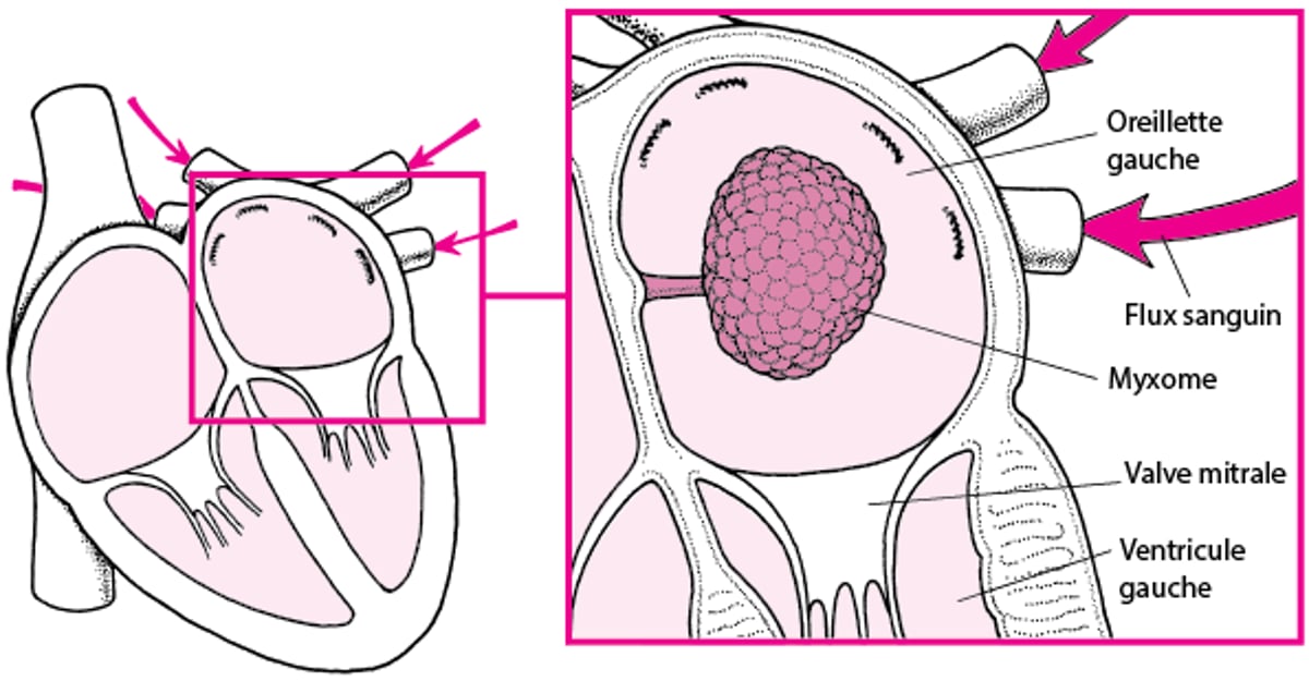 Comment un myxome peut obstruer le flux sanguin dans le cœur