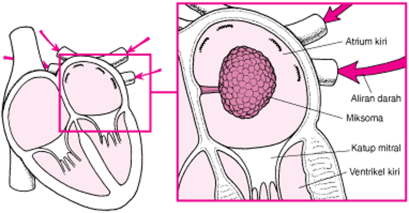 Bagaimana Miksoma Dapat Menyumbat Aliran Darah di Jantung
