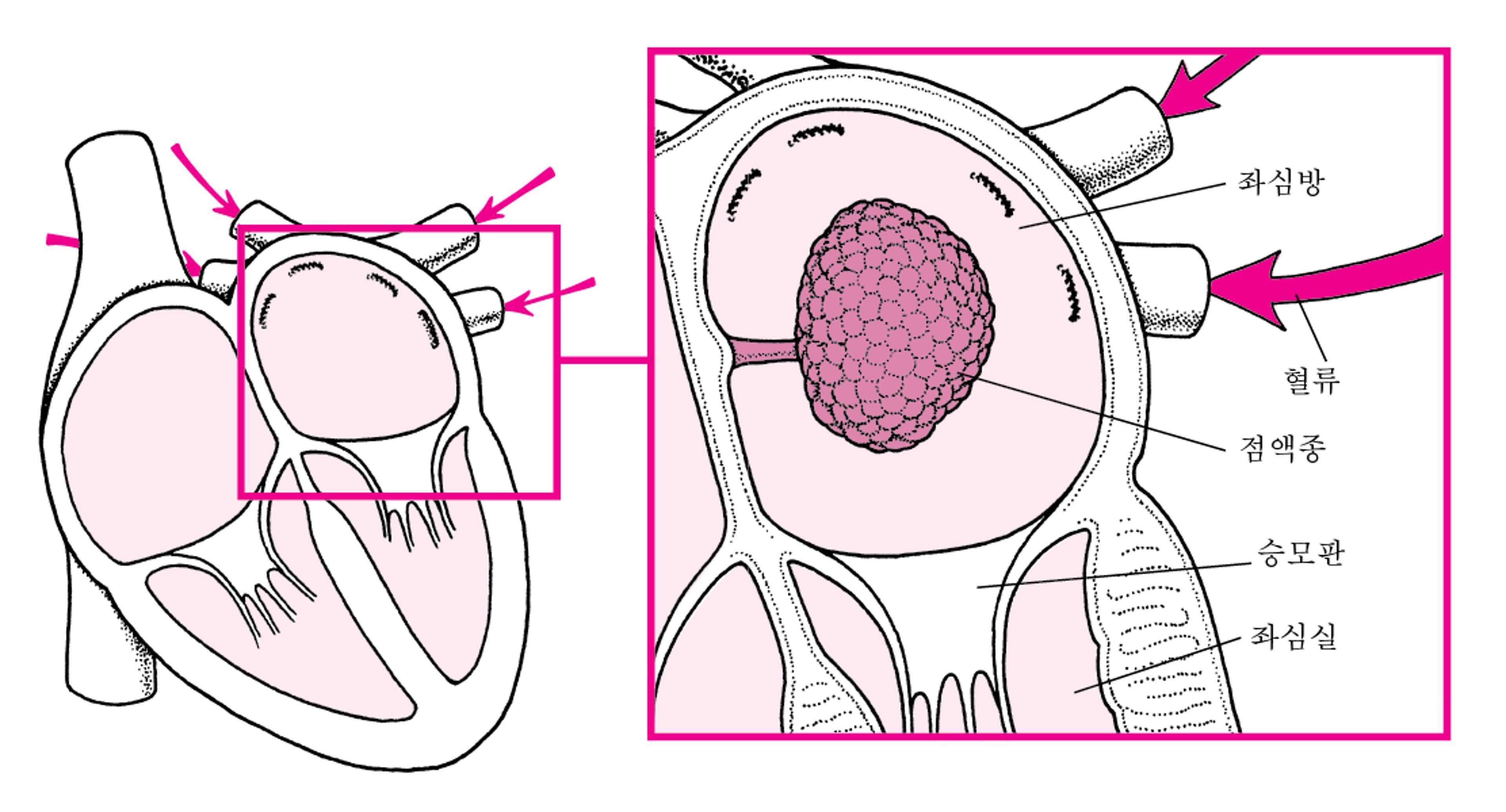 점액종이 심장 내 혈류를 차단하는 법