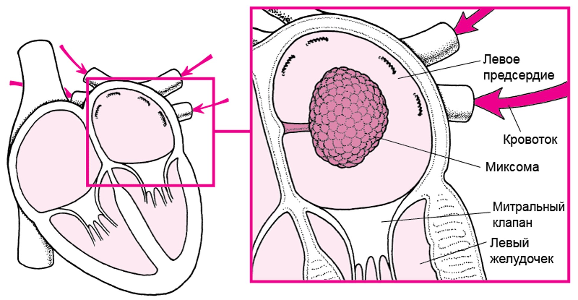 Как миксома может блокировать кровоток в сердце